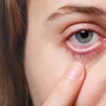 Infeksionet e syrit, shenjat dhe trajtimi sipas mjekes Burda